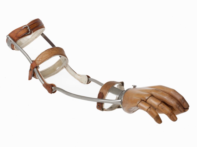 A prosthesis for forearm with movable thumb: 